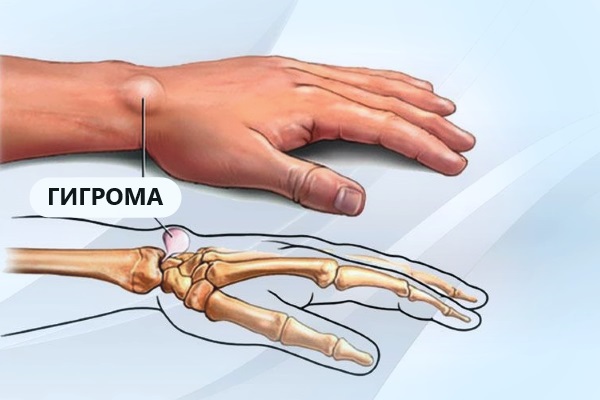 Гигрома - диагностика, лечение, профилактика. 13261.jpeg Гигрома - диагностика, лечение, профилактика. 13261.jpeg